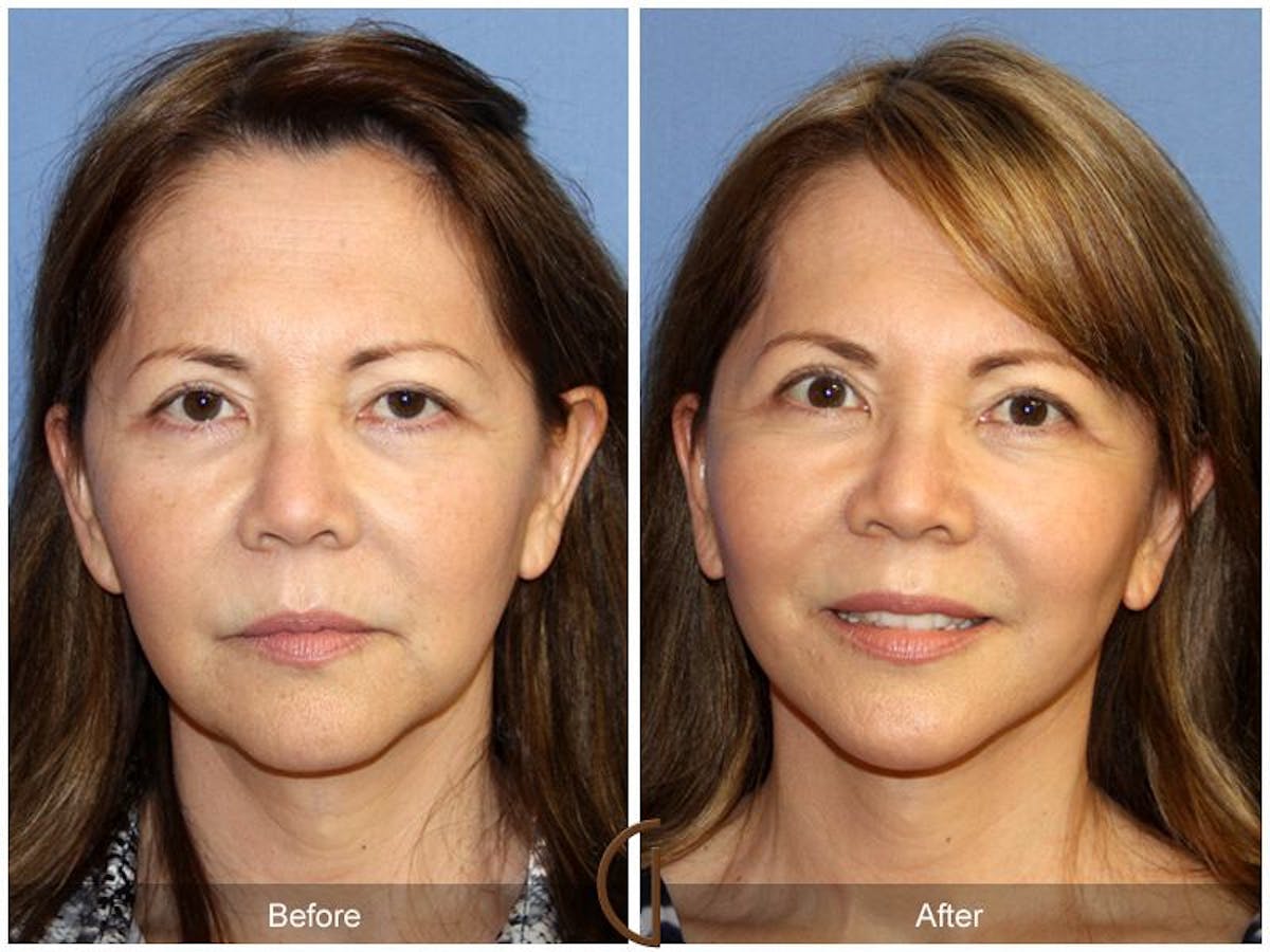 Facelift 60s Before & After Gallery - Patient 117910 - Image 2
