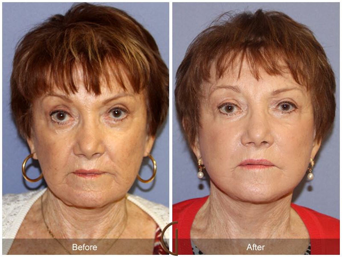 Facelift 70s Before & After Gallery - Patient 285599 - Image 2