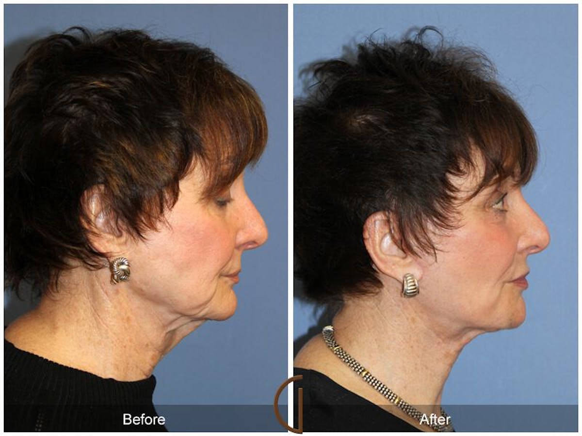 Facelift 70s Before & After Gallery - Patient 171236 - Image 3