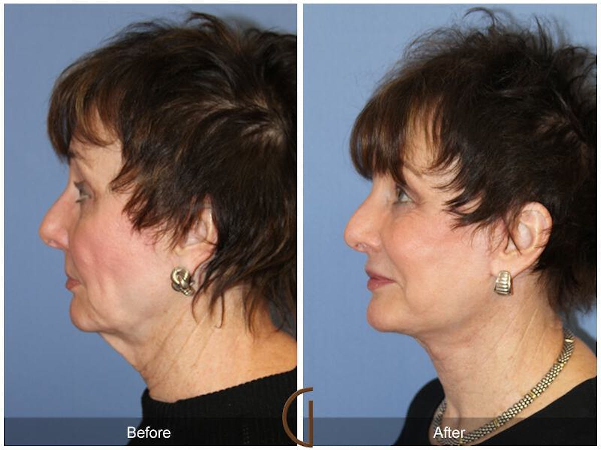 Facelift 70s Before & After Gallery - Patient 171236 - Image 1