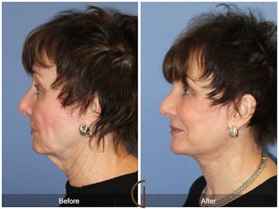 Facelift 70s Before & After Gallery - Patient 171236 - Image 1