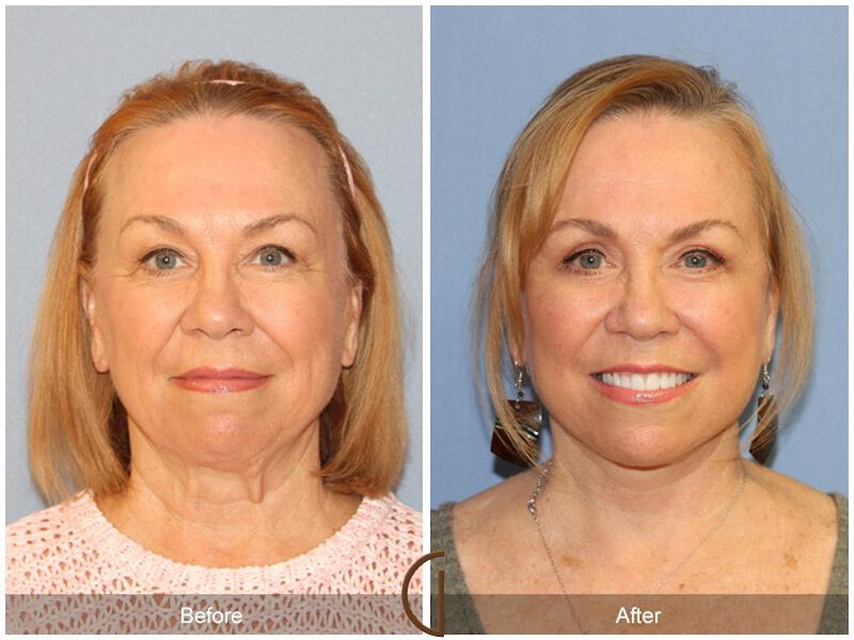 Facelift 60s Before & After Gallery - Patient 321846 - Image 2