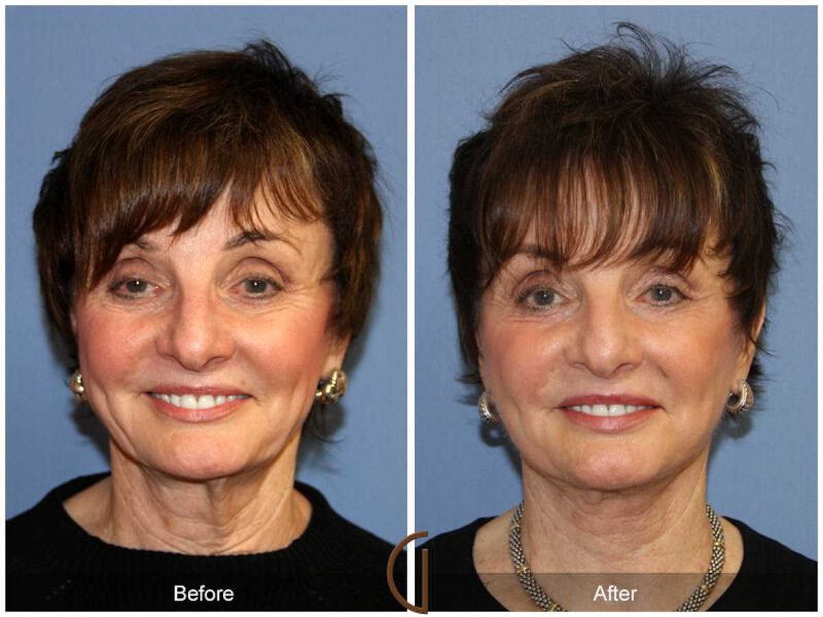 Facelift 70s Before & After Gallery - Patient 171236 - Image 2