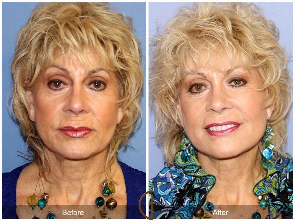 Facelift 70s Before & After Gallery - Patient 132269 - Image 2