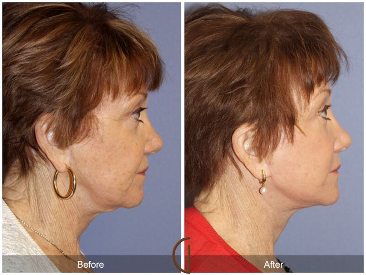 Facelift 70s Before & After Gallery - Patient 285599 - Image 3