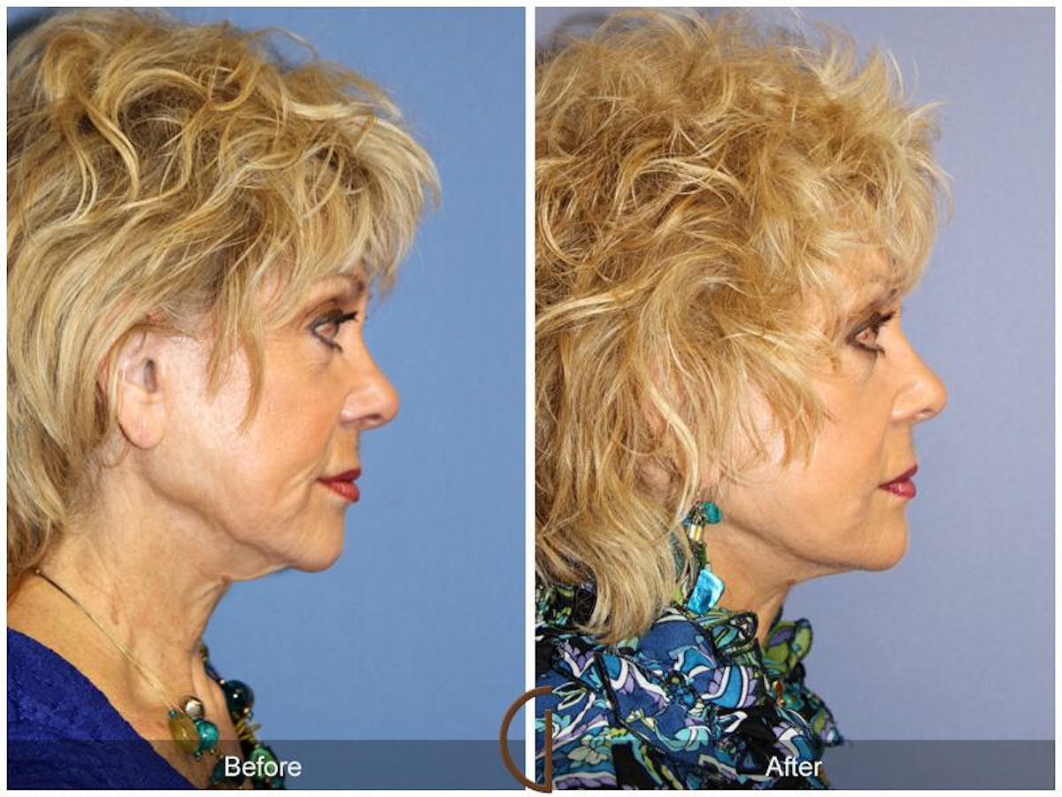 Facelift 70s Before & After Gallery - Patient 132269 - Image 3