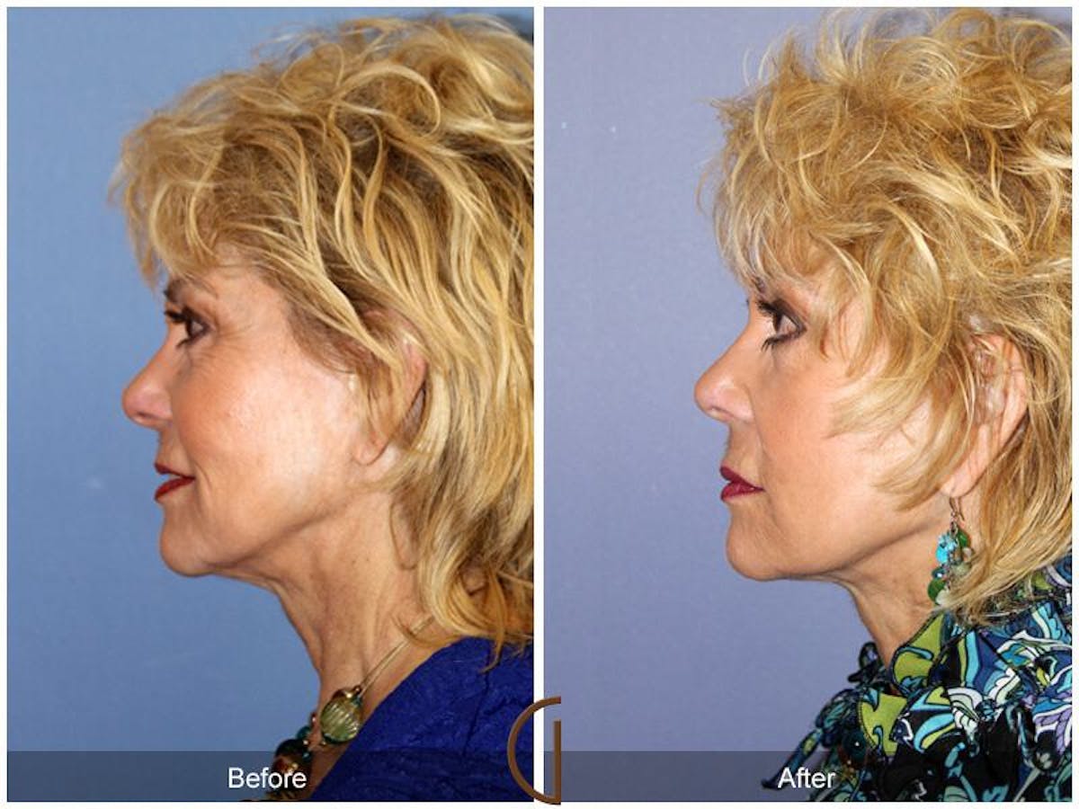 Facelift 70s Before & After Gallery - Patient 132269 - Image 1