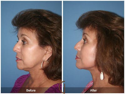 Facelift 60s Before & After Gallery - Patient 121931 - Image 1