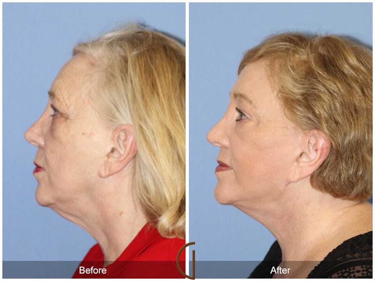 Facelift 70s Before & After Gallery - Patient 250238 - Image 1