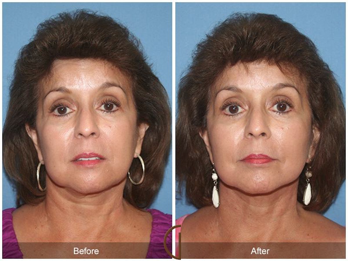 Facelift 60s Before & After Gallery - Patient 121931 - Image 2