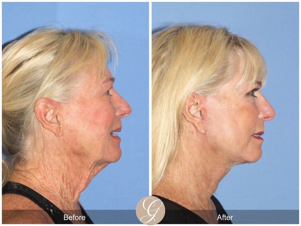 Facelift 60s Before & After Gallery - Patient 902369 - Image 3