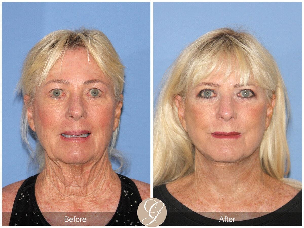 Facelift 60s Before & After Gallery - Patient 902369 - Image 2