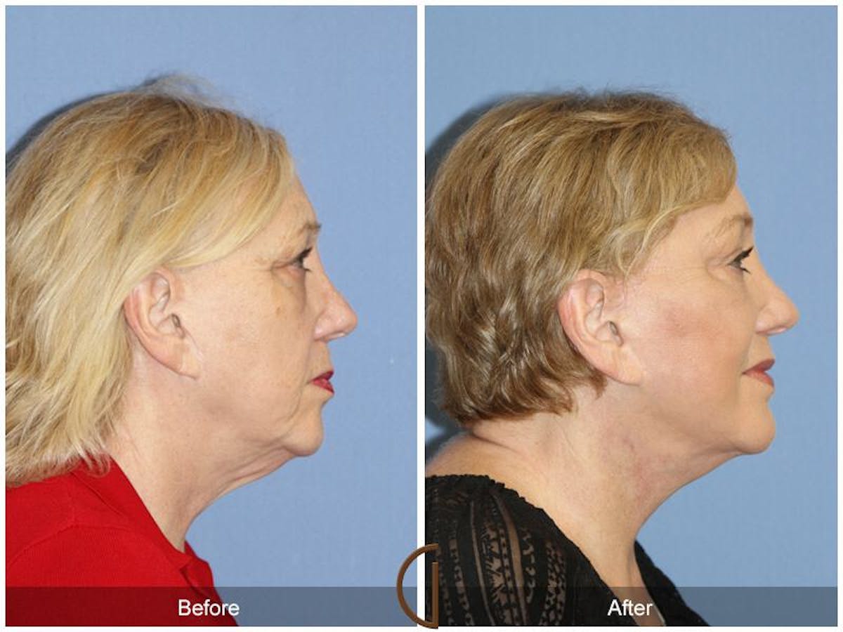 Facelift 70s Before & After Gallery - Patient 250238 - Image 3