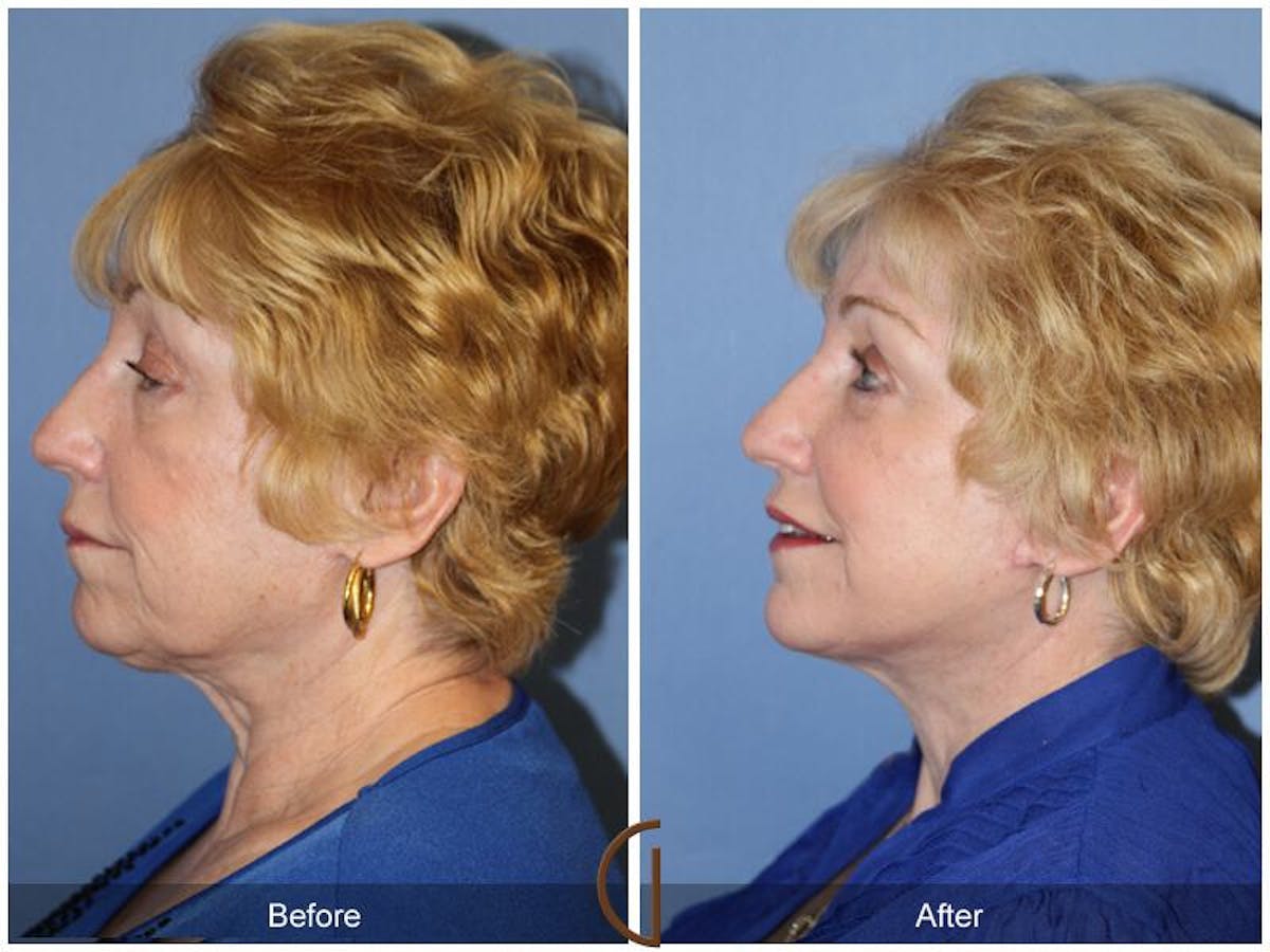 Facelift 70s Before & After Gallery - Patient 240782 - Image 1