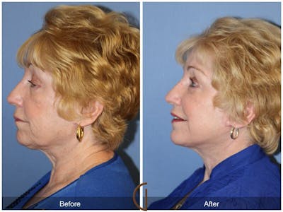 Facelift 70s Before & After Gallery - Patient 240782 - Image 1