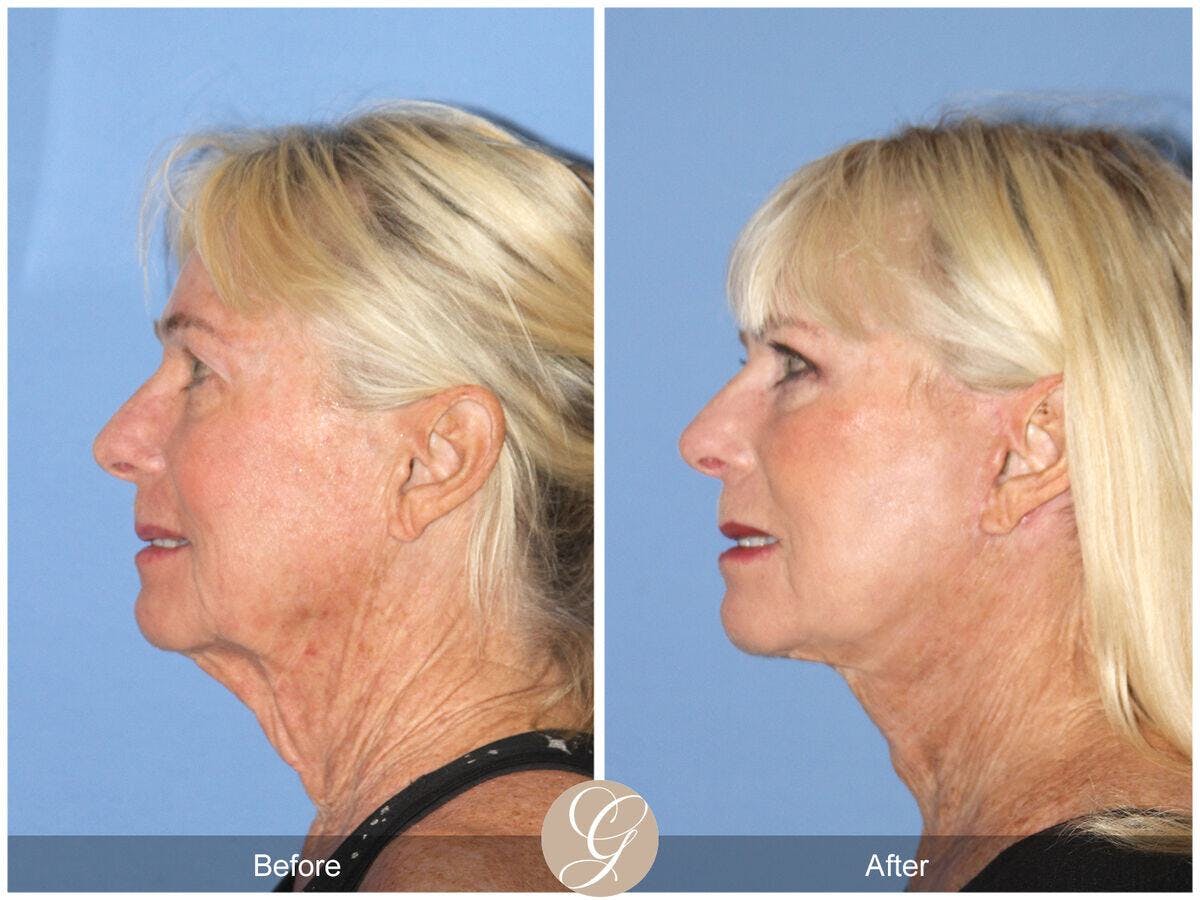Facelift 60s Before & After Gallery - Patient 902369 - Image 1