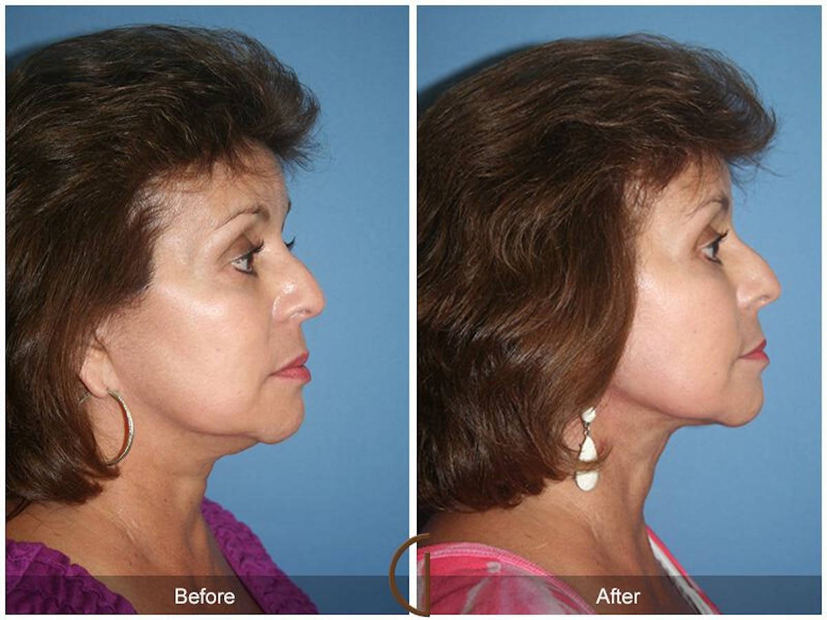 Facelift 60s Before & After Gallery - Patient 121931 - Image 3