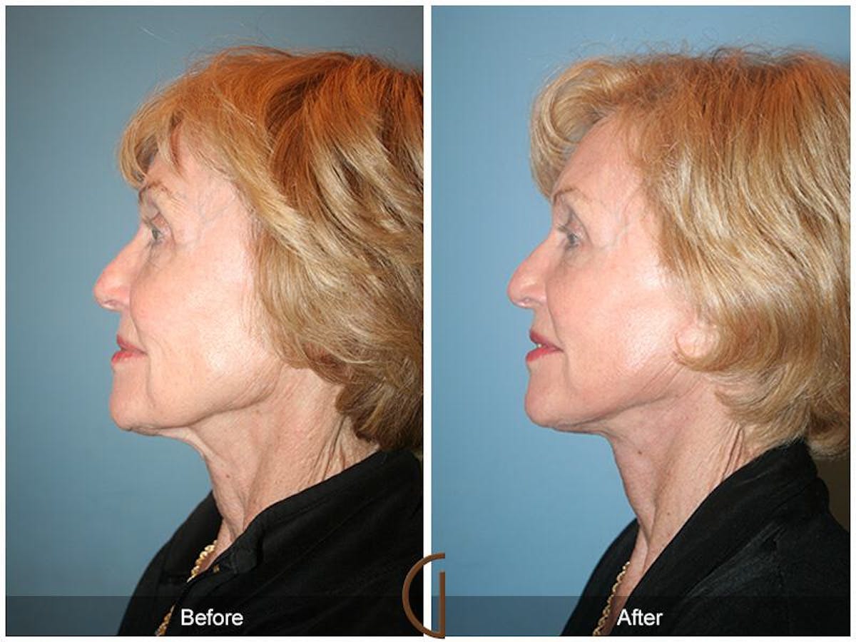 Facelift 70s Before & After Gallery - Patient 910835 - Image 1