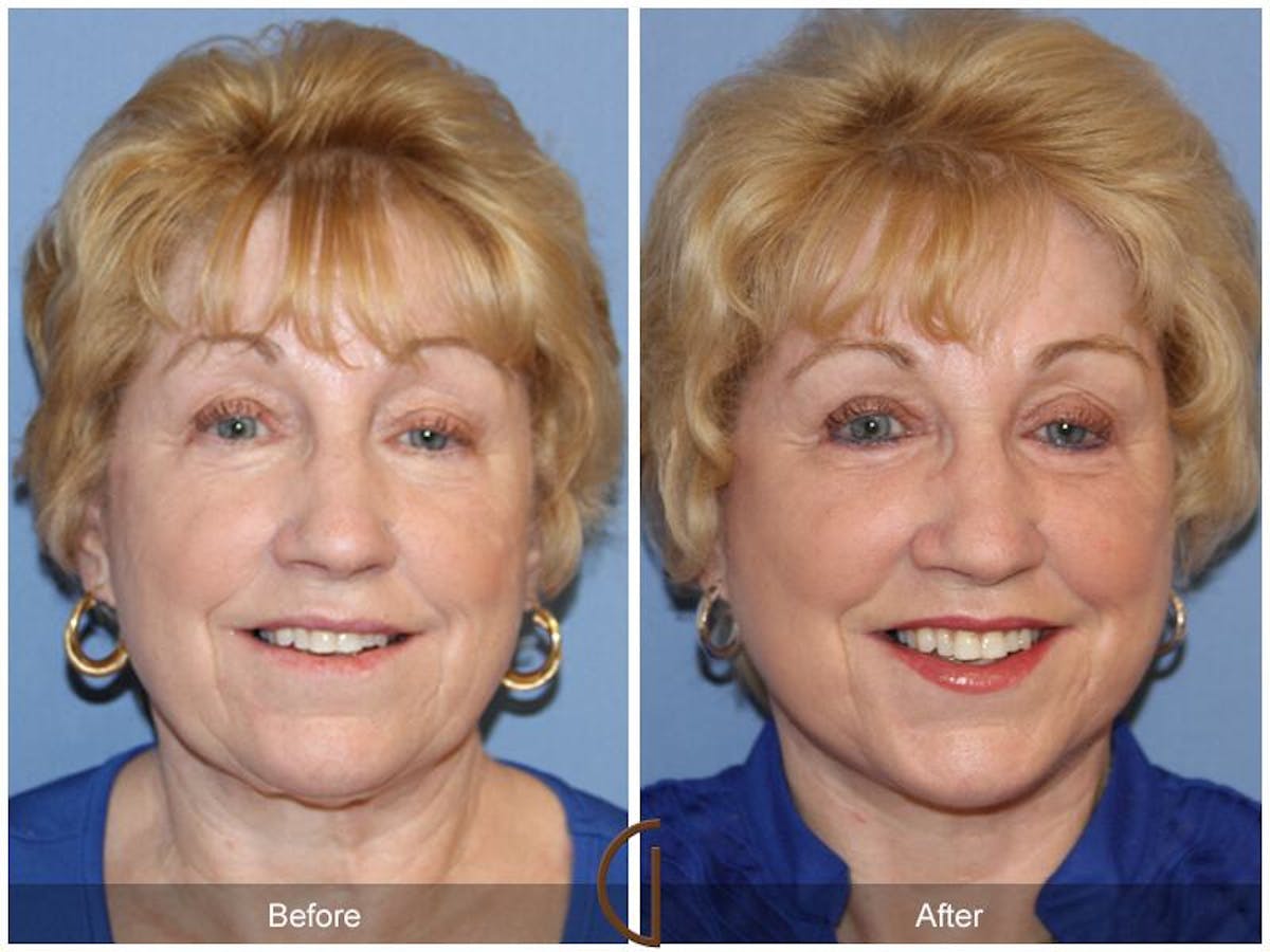 Facelift 70s Before & After Gallery - Patient 240782 - Image 2