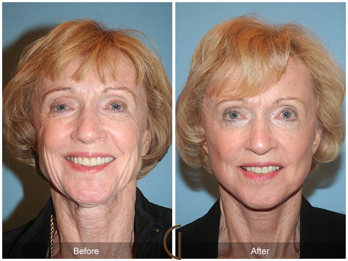 Facelift 70s Before & After Gallery - Patient 910835 - Image 2