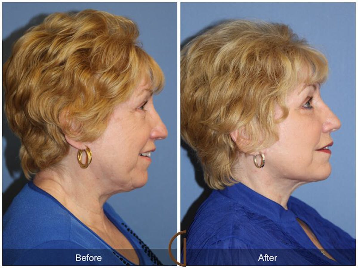 Facelift 70s Before & After Gallery - Patient 240782 - Image 3