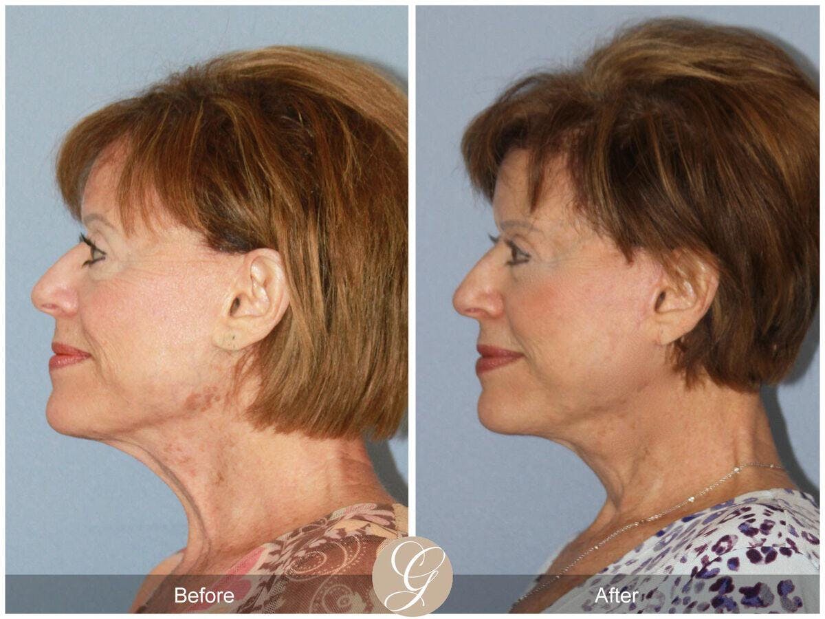 Facelift 70s Before & After Gallery - Patient 406719 - Image 1