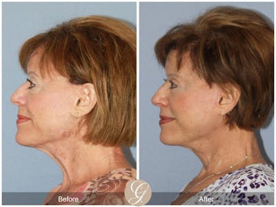 Facelift 70s Before & After Gallery - Patient 406719 - Image 1