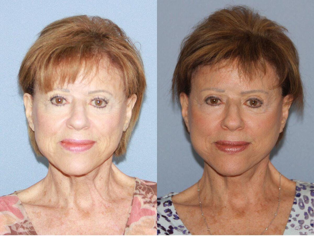 Facelift 70s Before & After Gallery - Patient 406719 - Image 2