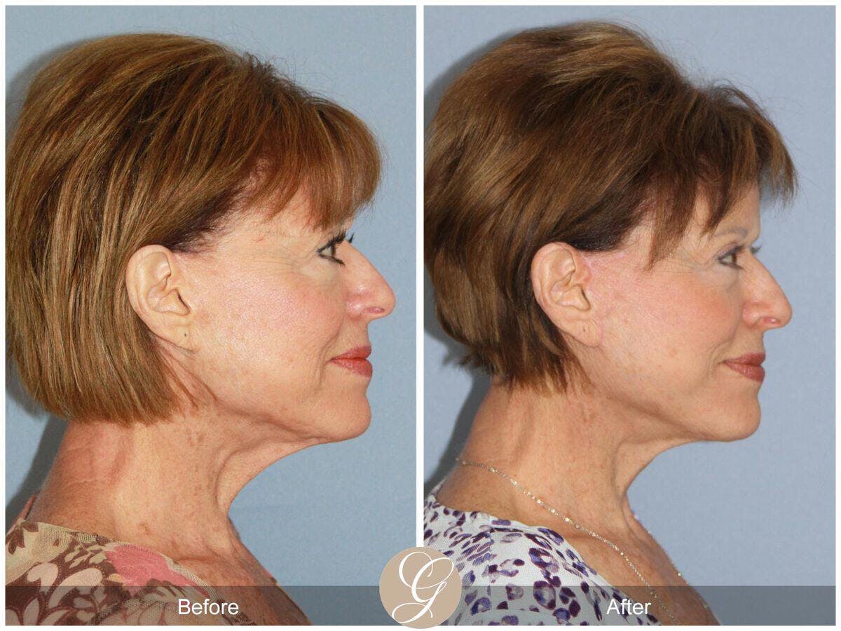 Facelift 70s Before & After Gallery - Patient 406719 - Image 3