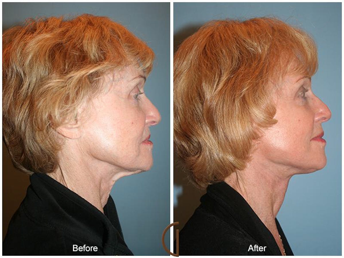 Facelift 70s Before & After Gallery - Patient 910835 - Image 3