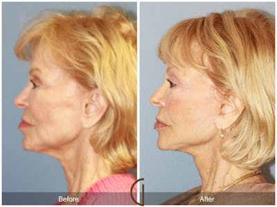 Facelift 70s Before & After Gallery - Patient 298873 - Image 1