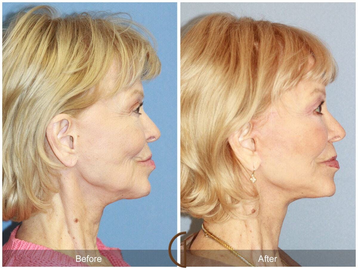 Facelift 70s Before & After Gallery - Patient 298873 - Image 3