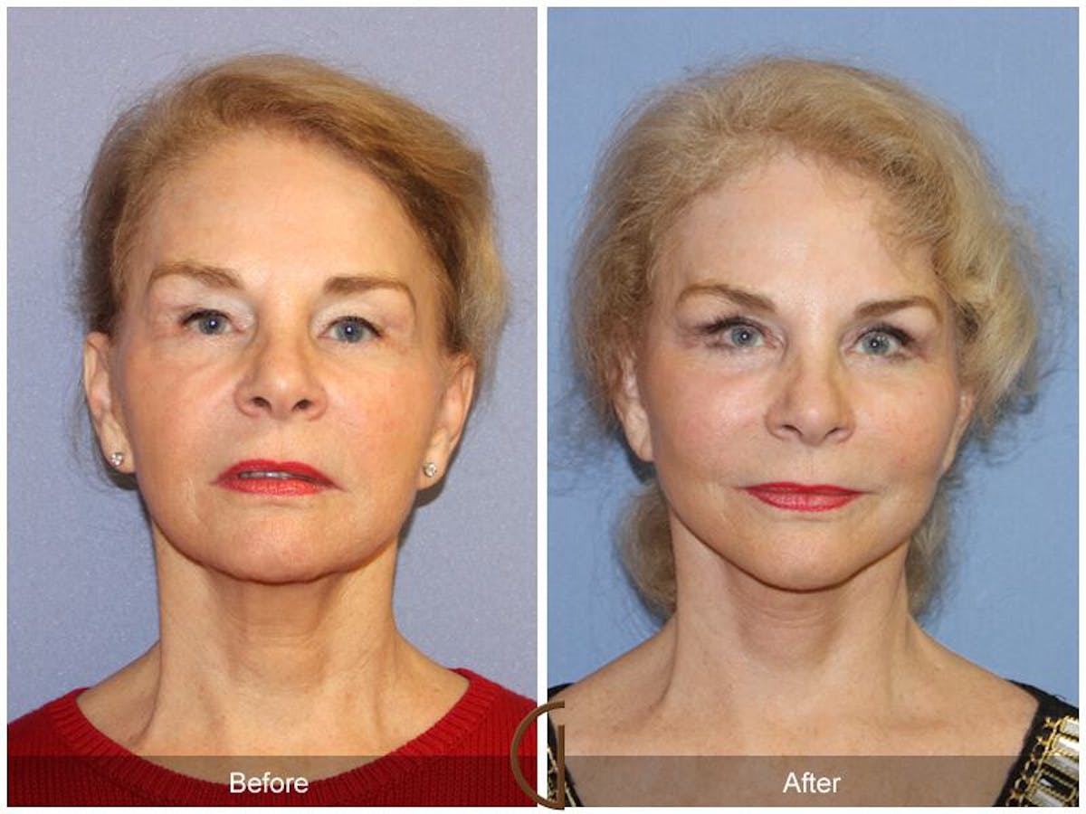 Facelift 70s Before & After Gallery - Patient 469664 - Image 2