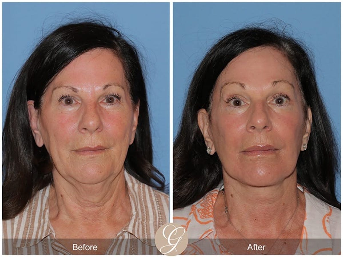 Preservation Facelift Before & After Gallery - Patient 251793 - Image 1