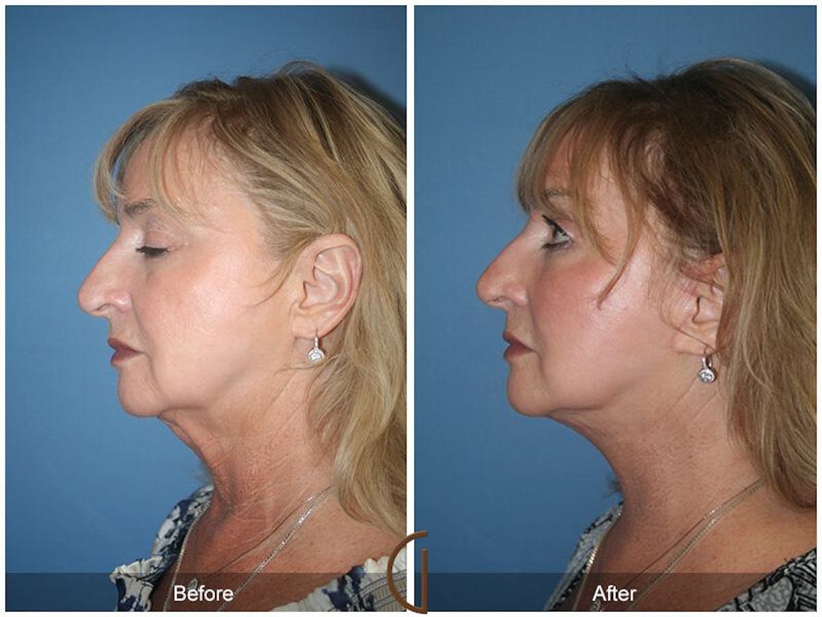 Facelift 60s Before & After Gallery - Patient 208206 - Image 1