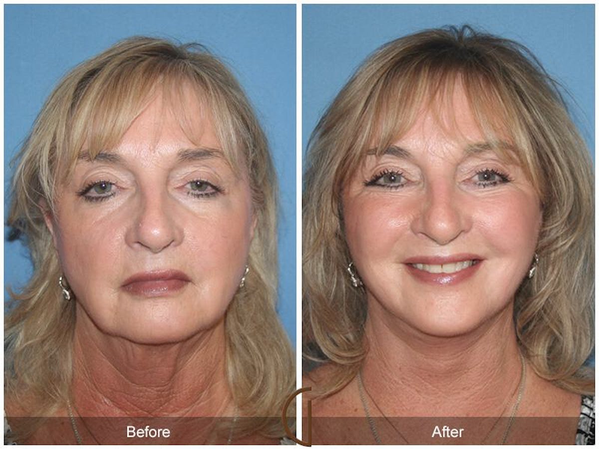 Facelift 60s Before & After Gallery - Patient 208206 - Image 2