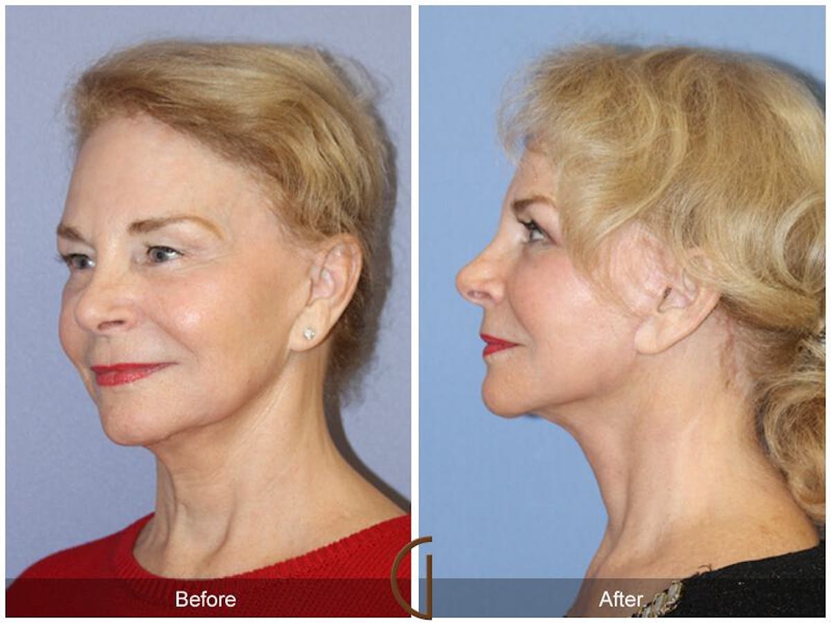Facelift 70s Before & After Gallery - Patient 469664 - Image 1