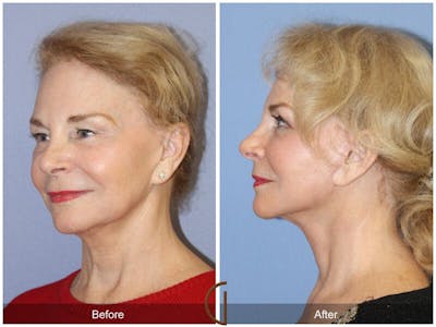 Facelift 70s Before & After Gallery - Patient 469664 - Image 1