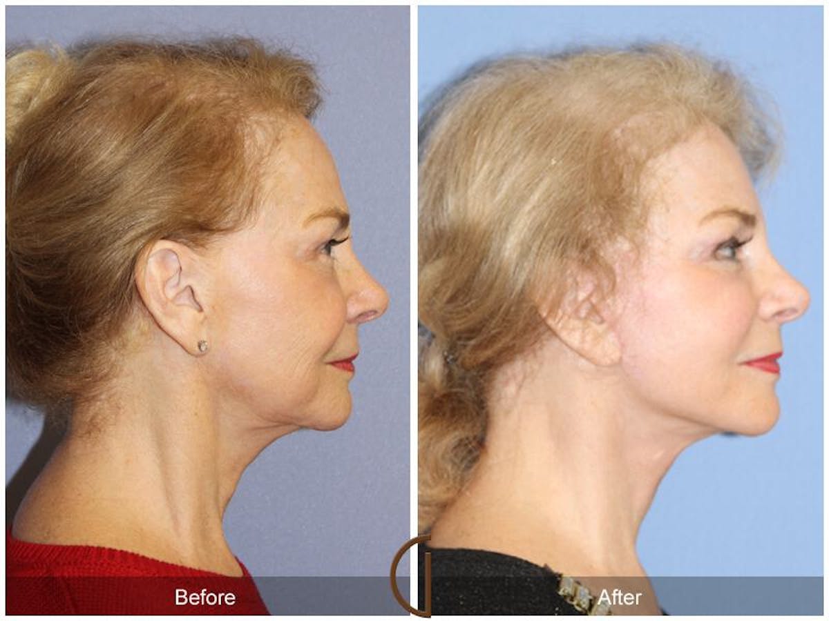Facelift 70s Before & After Gallery - Patient 469664 - Image 3