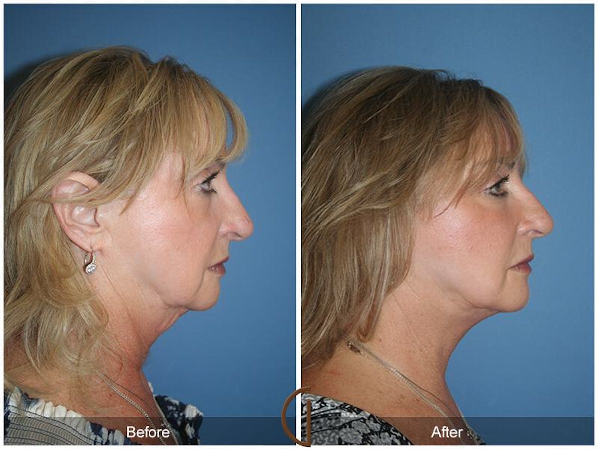 Facelift 60s Before & After Gallery - Patient 208206 - Image 3