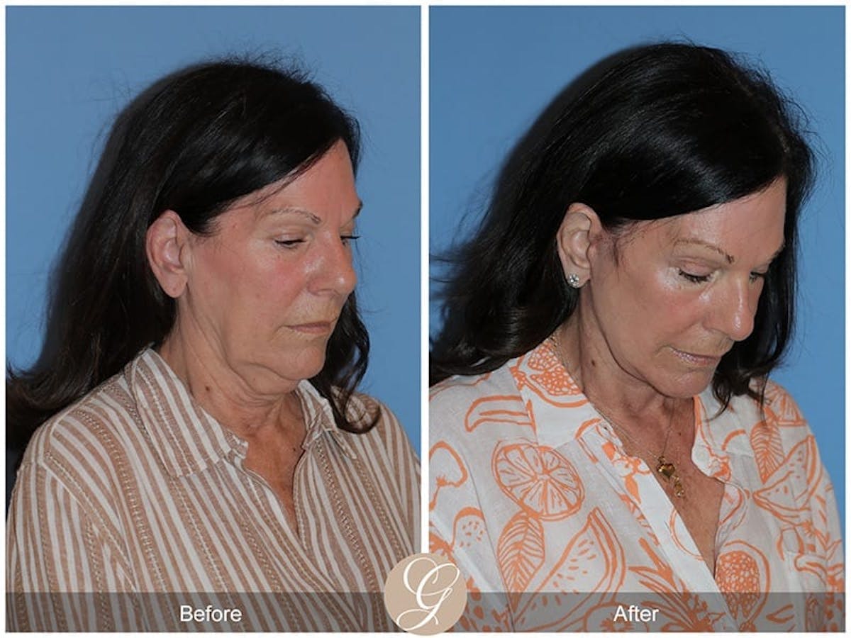 Preservation Facelift Before & After Gallery - Patient 251793 - Image 2