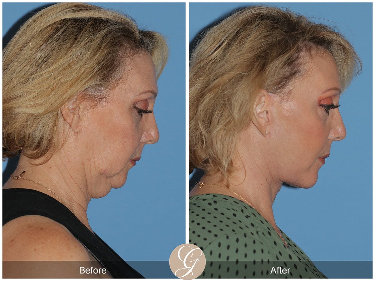Preservation Facelift Before & After Gallery - Patient 424798 - Image 2
