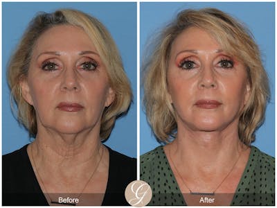 Preservation Facelift Before & After Gallery - Patient 424798 - Image 1