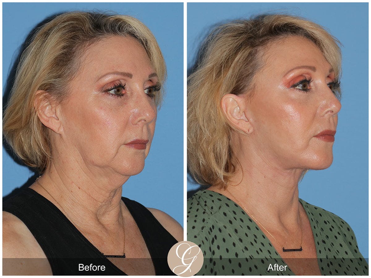 Preservation Facelift Before & After Gallery - Patient 424798 - Image 3