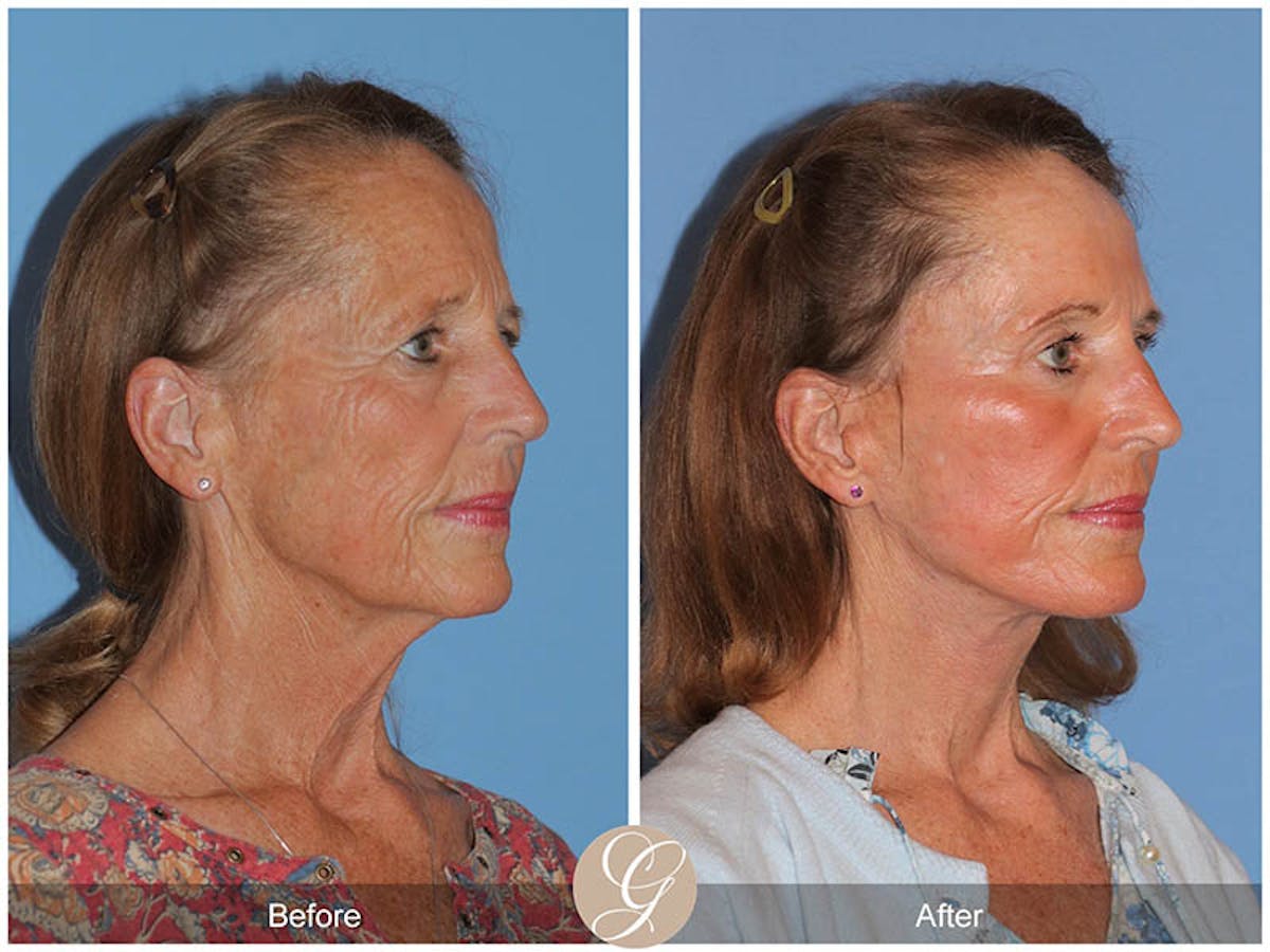 Preservation Facelift Before & After Gallery - Patient 157170 - Image 3