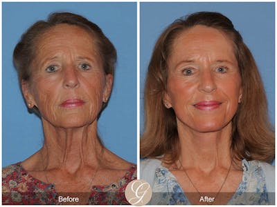 Preservation Facelift Before & After Gallery - Patient 157170 - Image 1