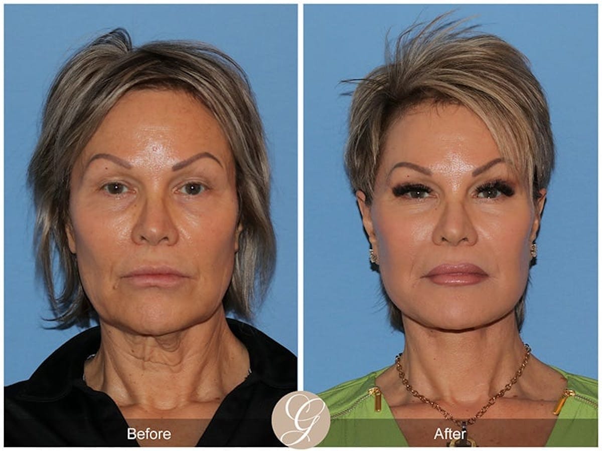 Preservation Facelift Before & After Gallery - Patient 397030 - Image 1