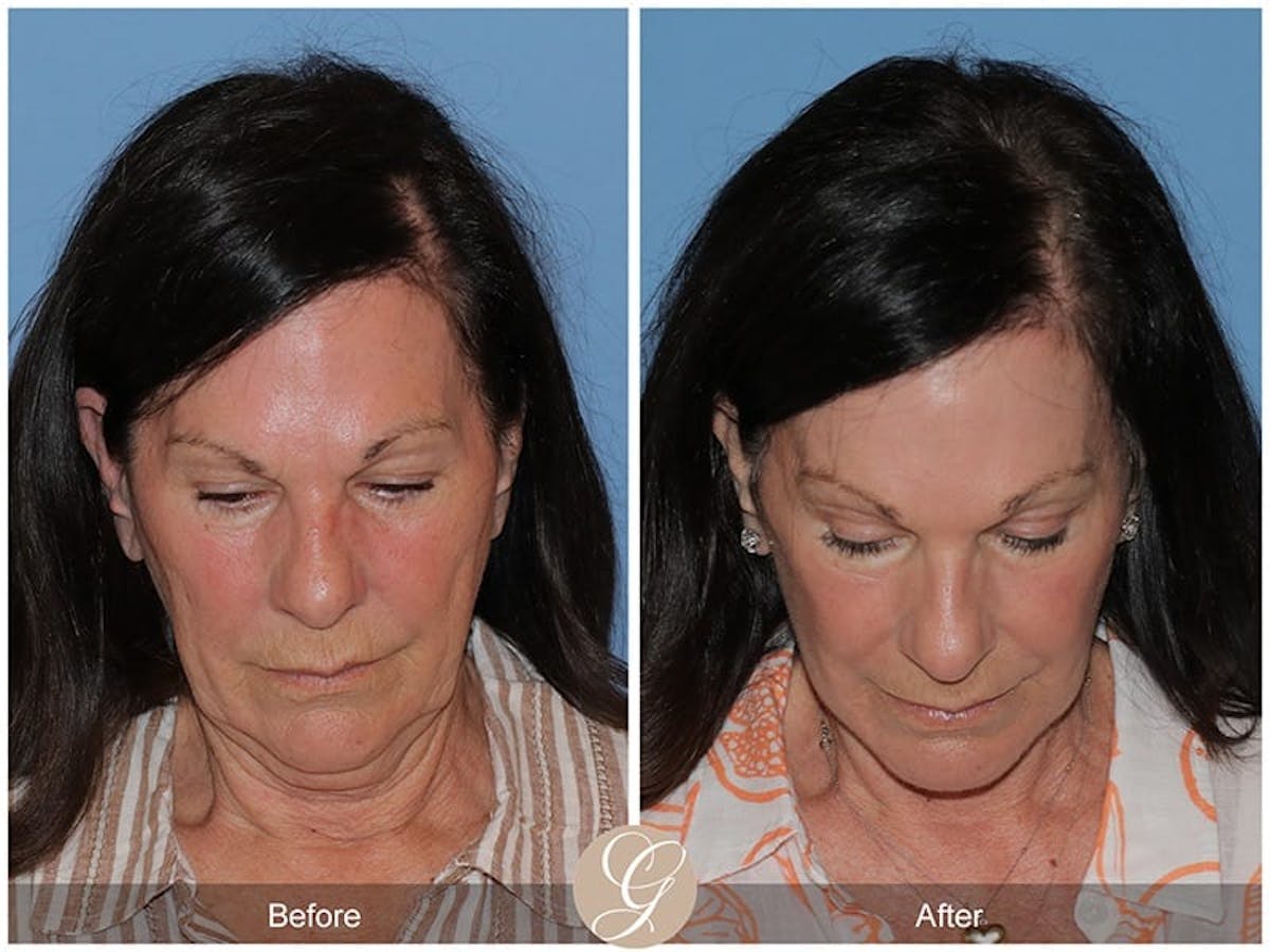 Preservation Facelift Before & After Gallery - Patient 251793 - Image 3