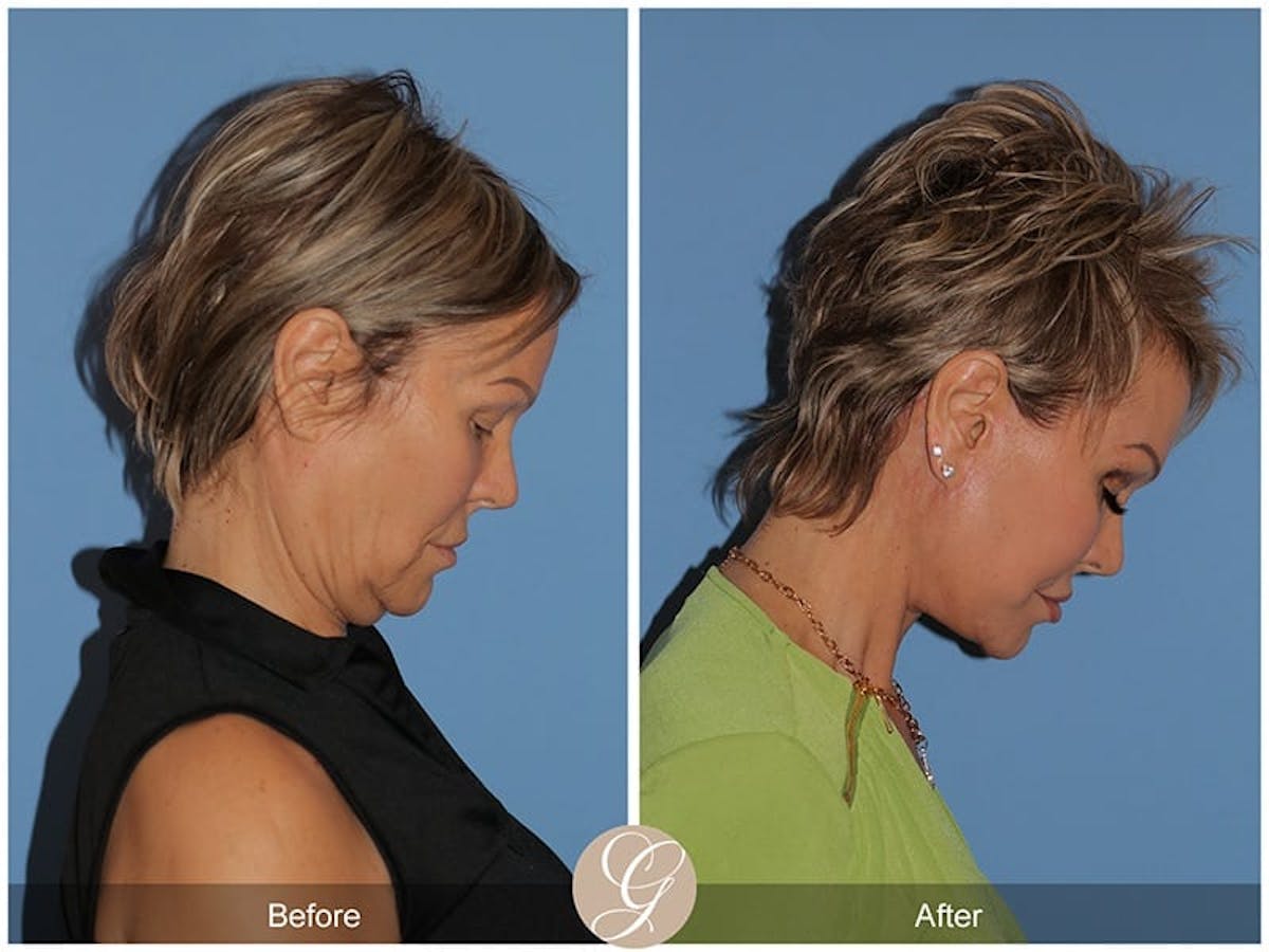 Preservation Facelift Before & After Gallery - Patient 397030 - Image 2