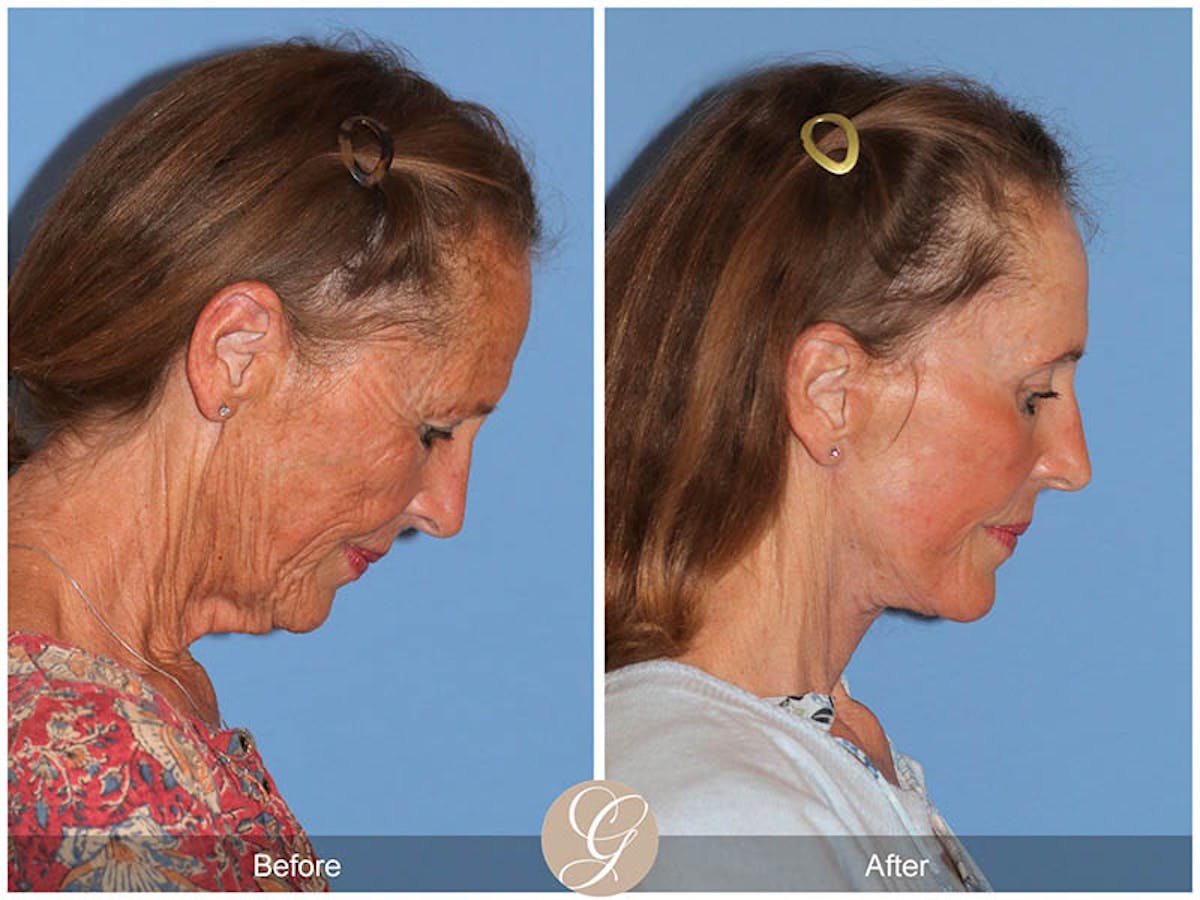 Preservation Facelift Before & After Gallery - Patient 157170 - Image 2